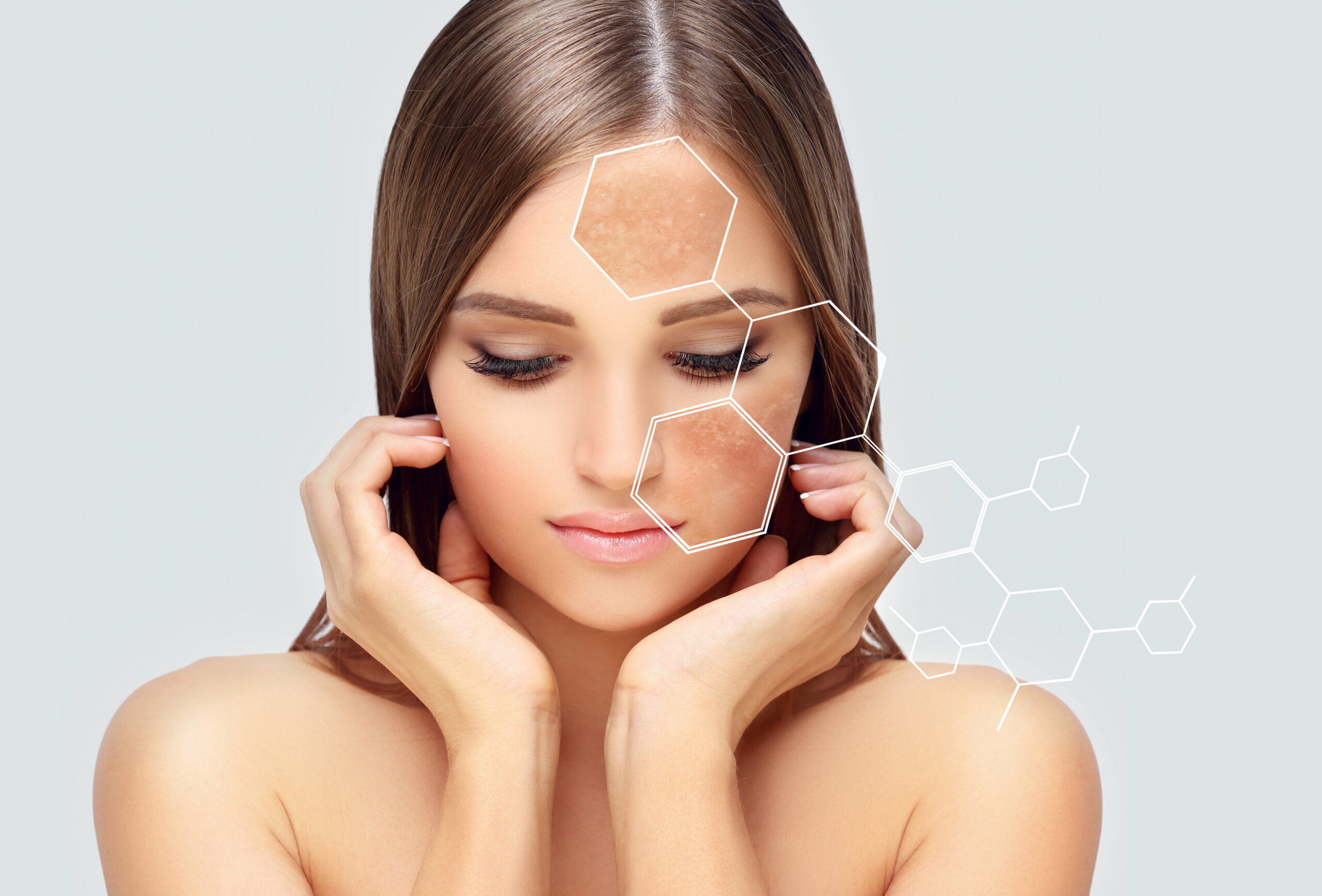 MELASMAS   Manchas oscuras en la piel, usualmente por sol u hormonas.  Agenda aquí